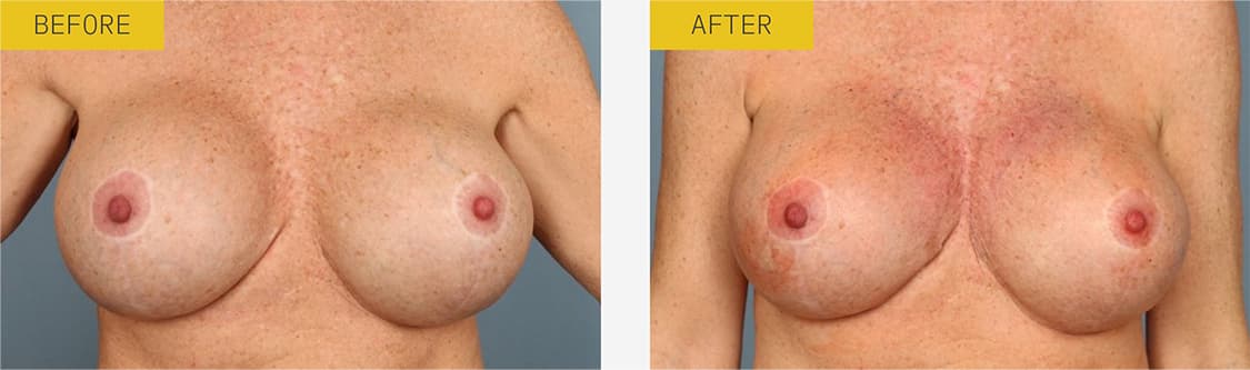 alloClae before and after case 1