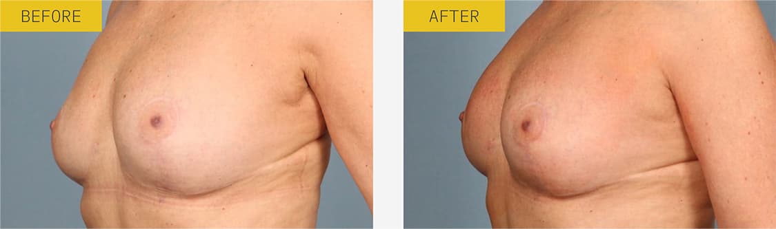 alloClae before and after case 2