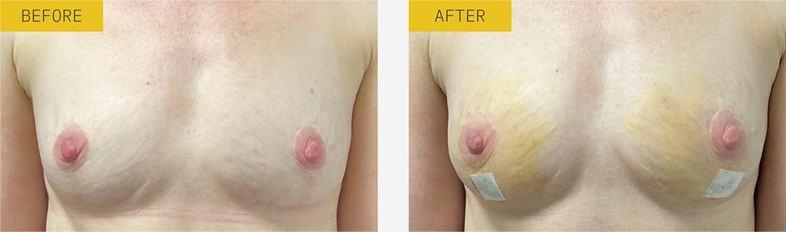 alloClae before and after case 3