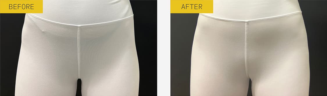alloClae before and after case 4
