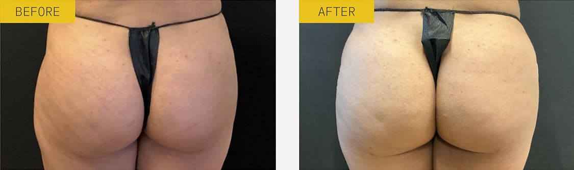 alloClae before and after case 5