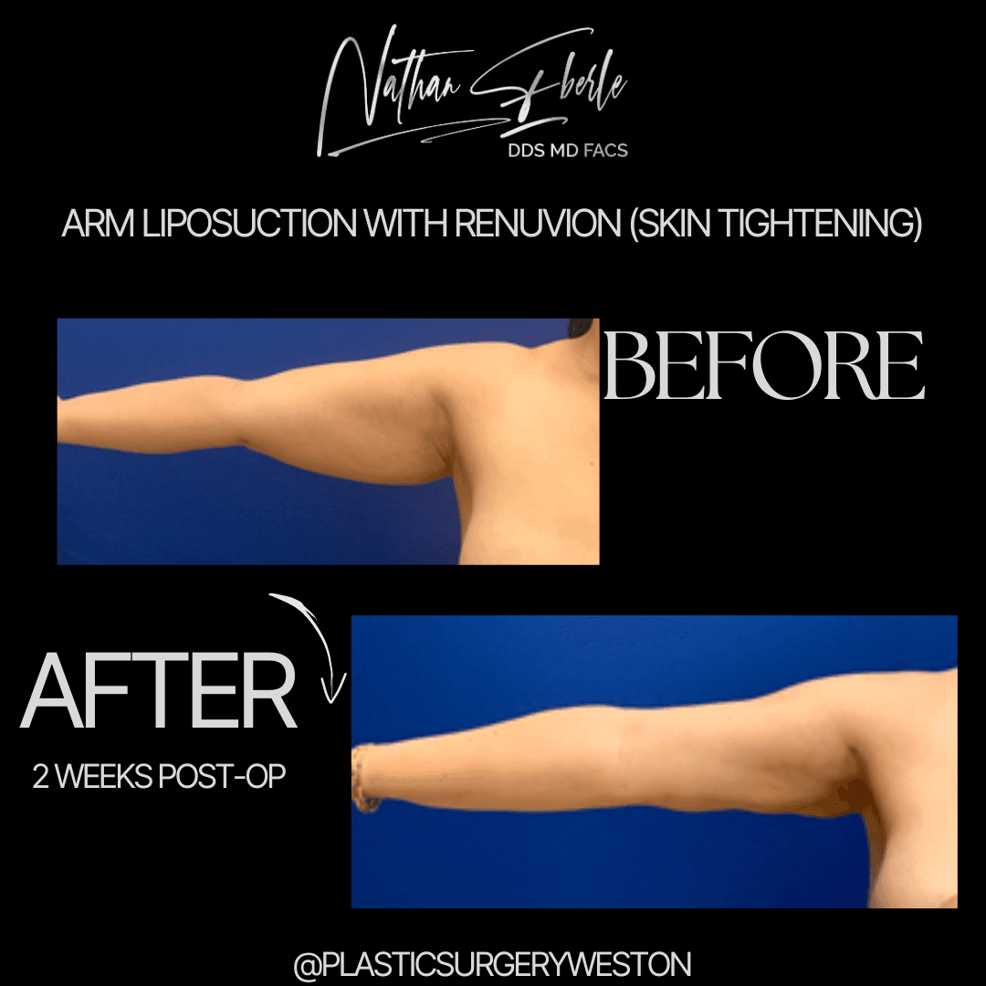 Arm Lift before and after case 1, actual patient at Weston Center for Plastic Surgery