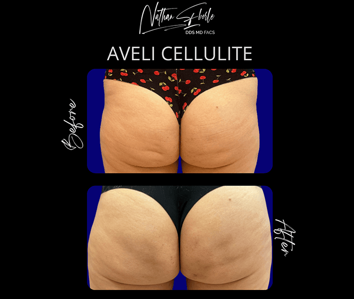 Aveli Cellulite before and after case 1, actual patient at Weston Center for Plastic Surgery