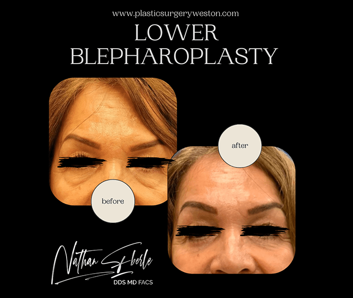 Blepharoplasty before and after case 10, actual patient at Weston Center for Plastic Surgery