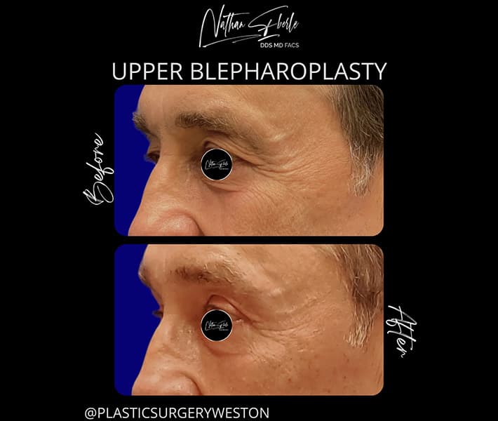 Blepharoplasty before and after case 11, actual patient at Weston Center for Plastic Surgery