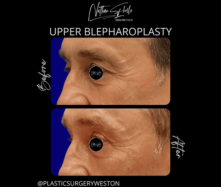 Blepharoplasty before and after case 11, actual patient at Weston Center for Plastic Surgery