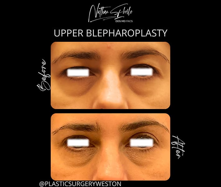 Blepharoplasty before and after case 12, actual patient at Weston Center for Plastic Surgery