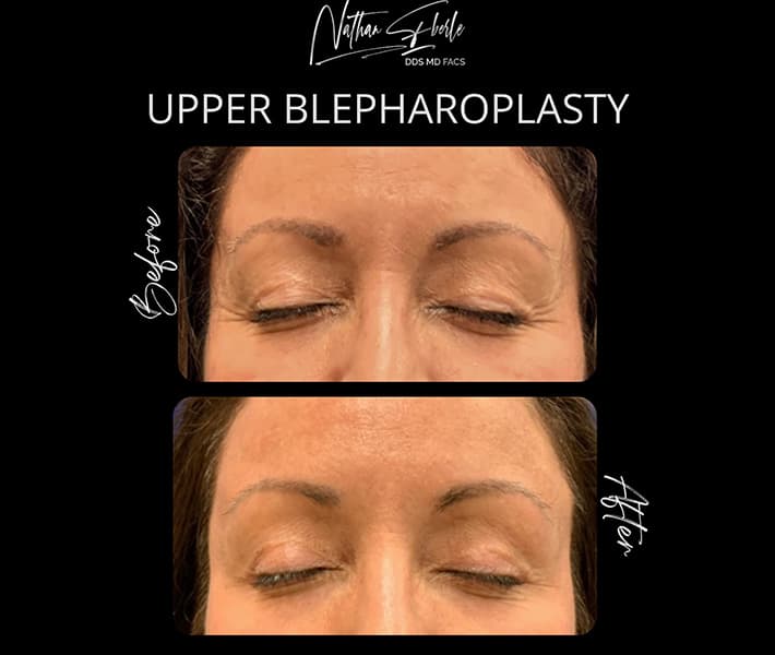 Blepharoplasty before and after case 13, actual patient at Weston Center for Plastic Surgery