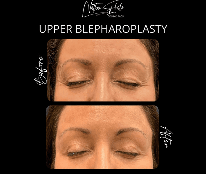 Blepharoplasty before and after case 13, actual patient at Weston Center for Plastic Surgery