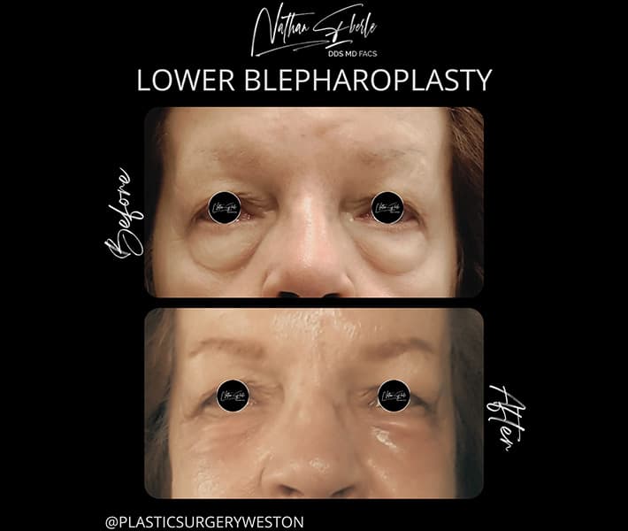 Blepharoplasty before and after case 14, actual patient at Weston Center for Plastic Surgery