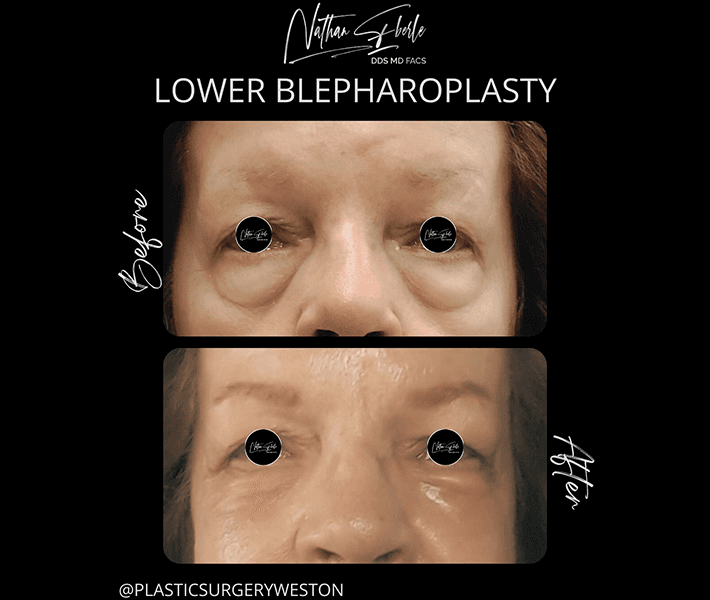 Blepharoplasty before and after case 14, actual patient at Weston Center for Plastic Surgery