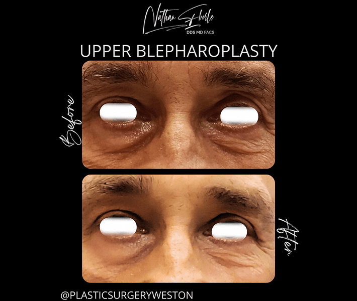 Blepharoplasty before and after case 15, actual patient at Weston Center for Plastic Surgery