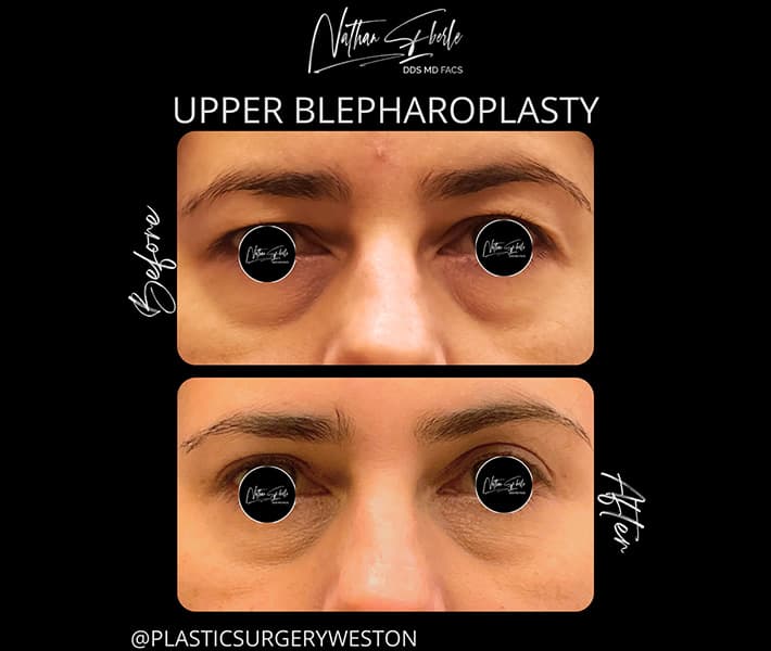 Blepharoplasty before and after case 16, actual patient at Weston Center for Plastic Surgery