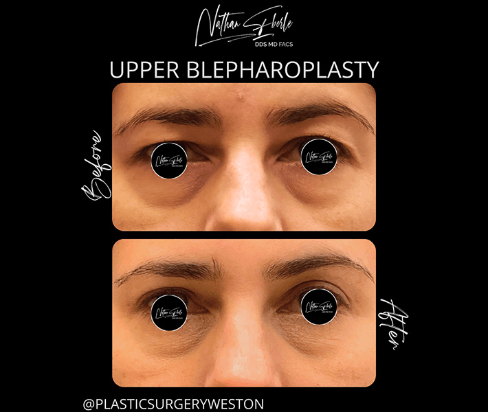 Blepharoplasty before and after case 16, actual patient at Weston Center for Plastic Surgery