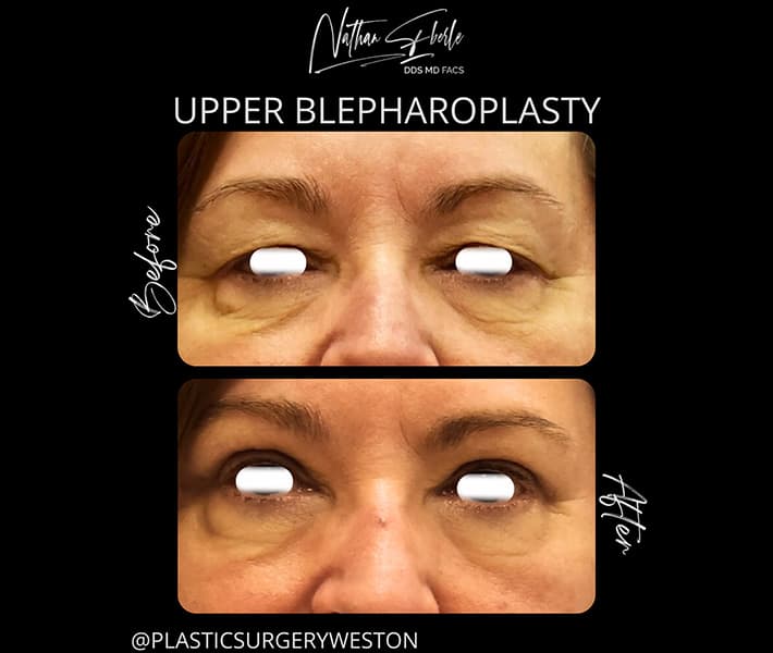 Blepharoplasty before and after case 17, actual patient at Weston Center for Plastic Surgery