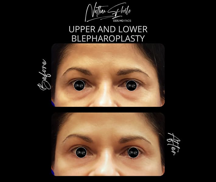 Blepharoplasty before and after case 18, actual patient at Weston Center for Plastic Surgery