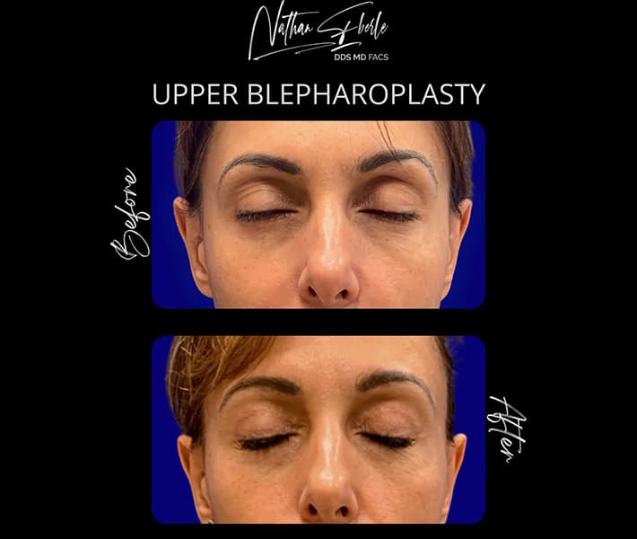 Blepharoplasty before and after case 19, actual patient at Weston Center for Plastic Surgery