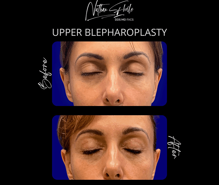Blepharoplasty before and after case 19, actual patient at Weston Center for Plastic Surgery