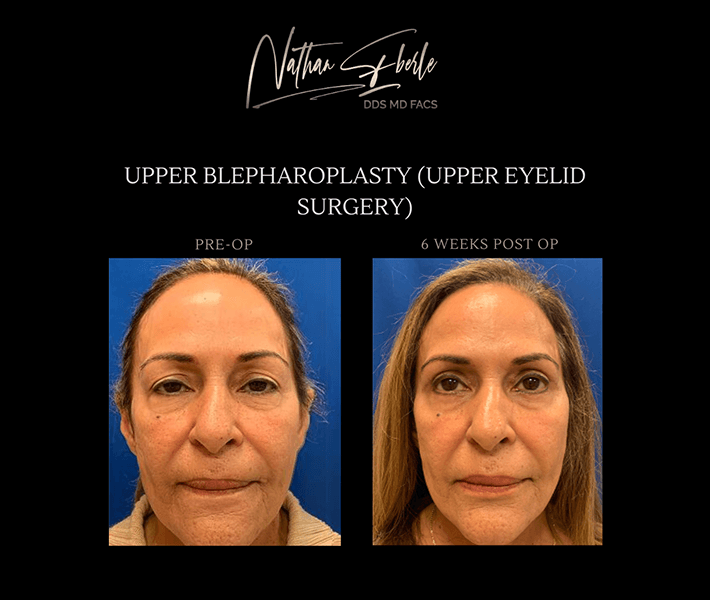 Blepharoplasty before and after case 2, actual patient at Weston Center for Plastic Surgery