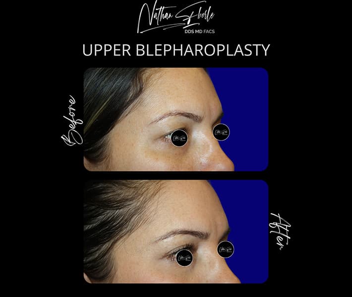 Blepharoplasty before and after case 20, actual patient at Weston Center for Plastic Surgery