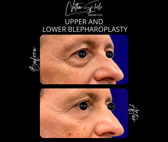 Blepharoplasty before and after case 21, actual patient at Weston Center for Plastic Surgery