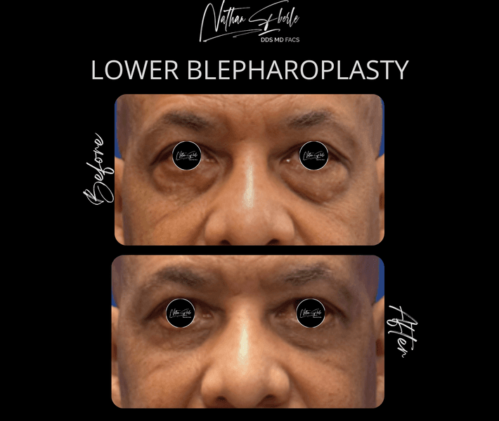 Blepharoplasty case 22 before and after results at Weston Center for Plastic Surgery