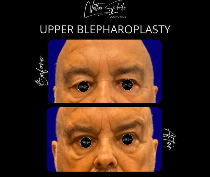 Blepharoplasty case 23 before and after results at Weston Center for Plastic Surgery