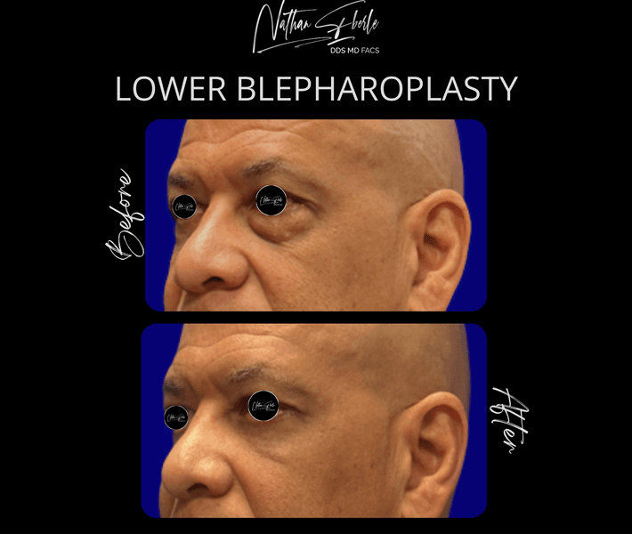 Blepharoplasty case 24 before and after results at Weston Center for Plastic Surgery