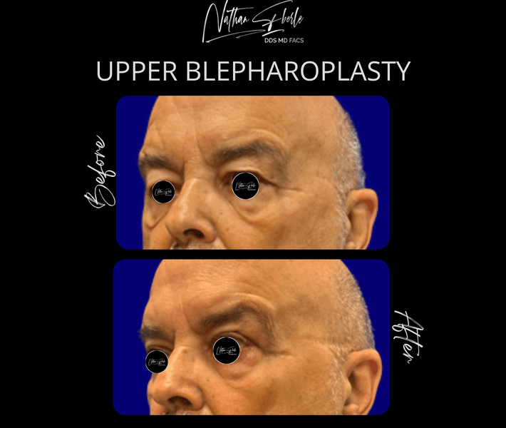 Blepharoplasty case 25 before and after results at Weston Center for Plastic Surgery