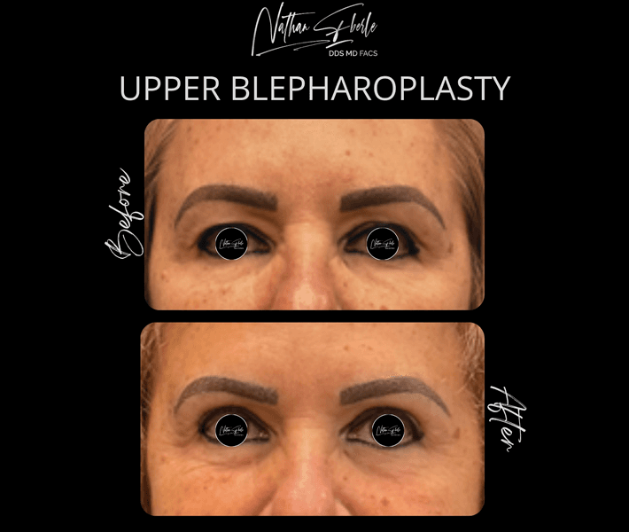 Blepharoplasty case 26 before and after results at Weston Center for Plastic Surgery
