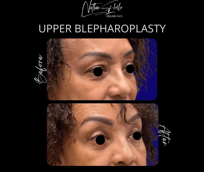 Blepharoplasty case 27 before and after results at Weston Center for Plastic Surgery