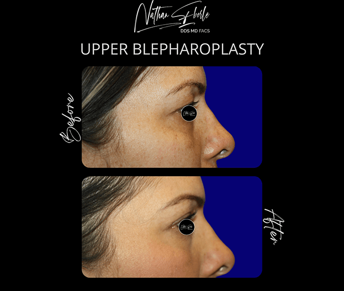 Blepharoplasty before and after case 3, actual patient at Weston Center for Plastic Surgery