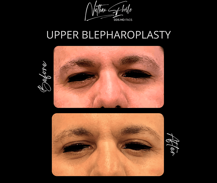 Blepharoplasty before and after case 4, actual patient at Weston Center for Plastic Surgery