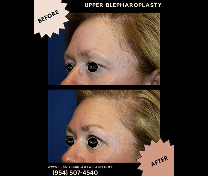 Blepharoplasty before and after case 5, actual patient at Weston Center for Plastic Surgery