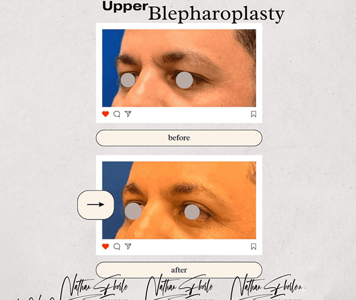 Blepharoplasty before and after case 6, actual patient at Weston Center for Plastic Surgery