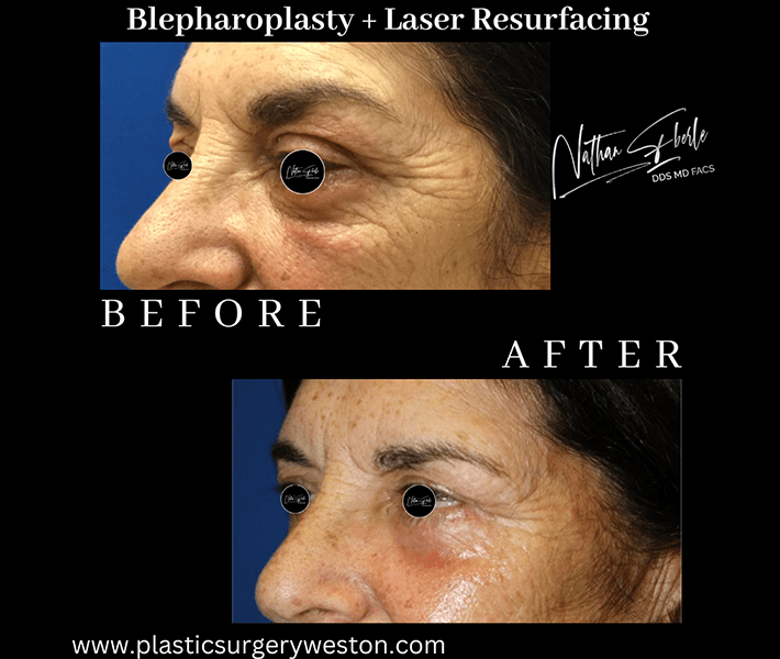Blepharoplasty before and after case 7, actual patient at Weston Center for Plastic Surgery
