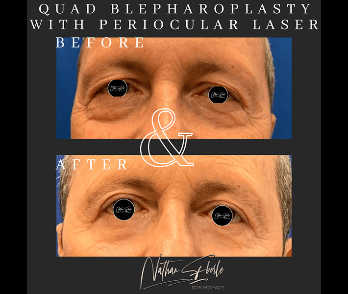 Blepharoplasty before and after case 8, actual patient at Weston Center for Plastic Surgery