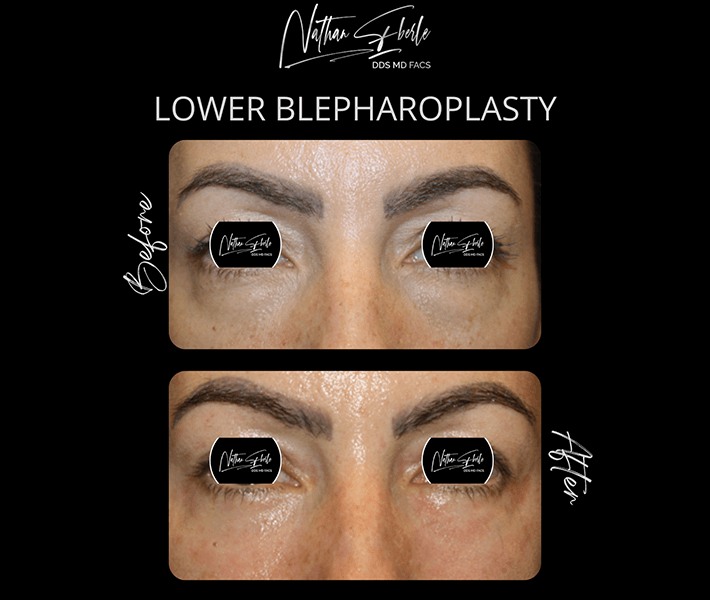 Blepharoplasty before and after case 9, actual patient at Weston Center for Plastic Surgery