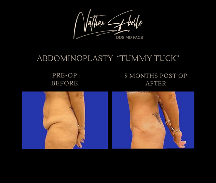 Body Plastic Surgery before and after case 1, actual patient at Weston Center for Plastic Surgery