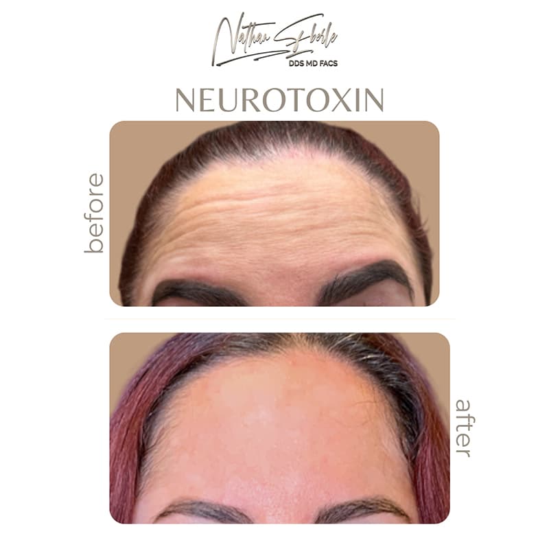 Botox & Dysport before and after case 1, actual patient at Weston Center for Plastic Surgery