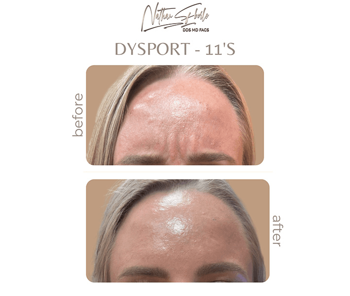 Botox case 2 before and after results at Weston Center for Plastic Surgery