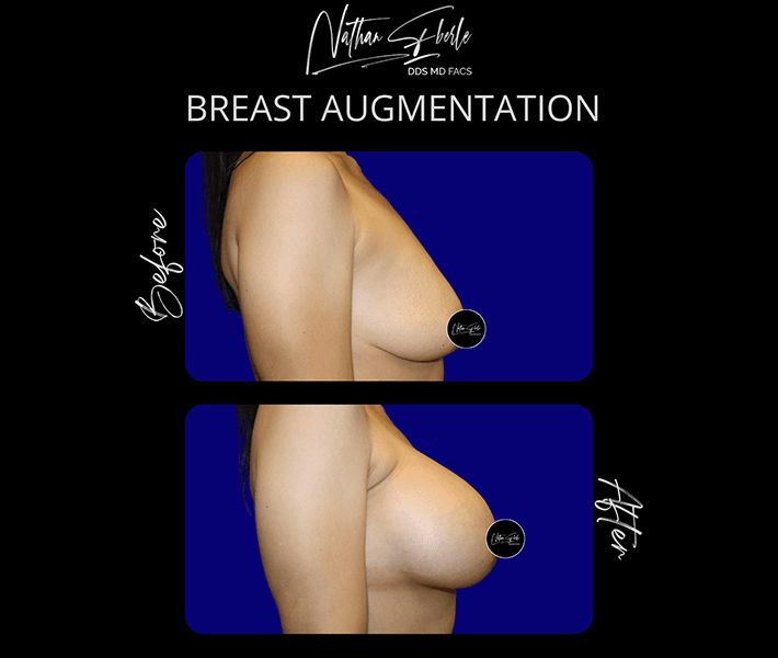 Breast Augmentation before and after case 10, actual patient at Weston Center for Plastic Surgery