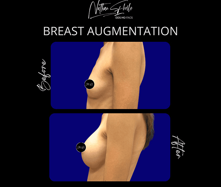 Breast Augmentation before and after case 104, actual patient at Weston Center for Plastic Surgery