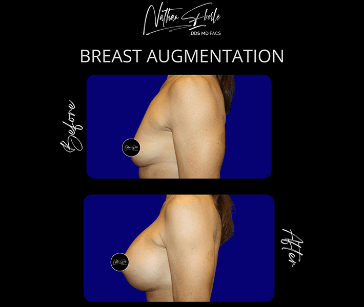 Breast Augmentation before and after case 110, actual patient at Weston Center for Plastic Surgery