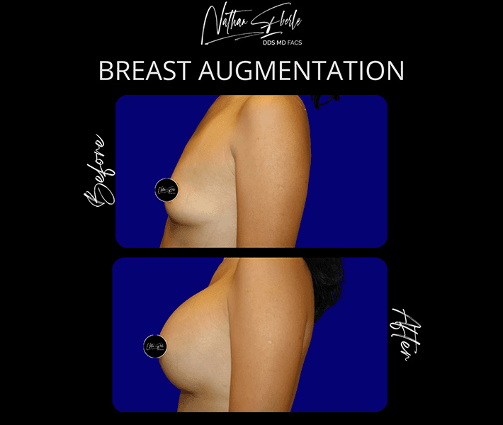 Breast Augmentation before and after case 113, actual patient at Weston Center for Plastic Surgery