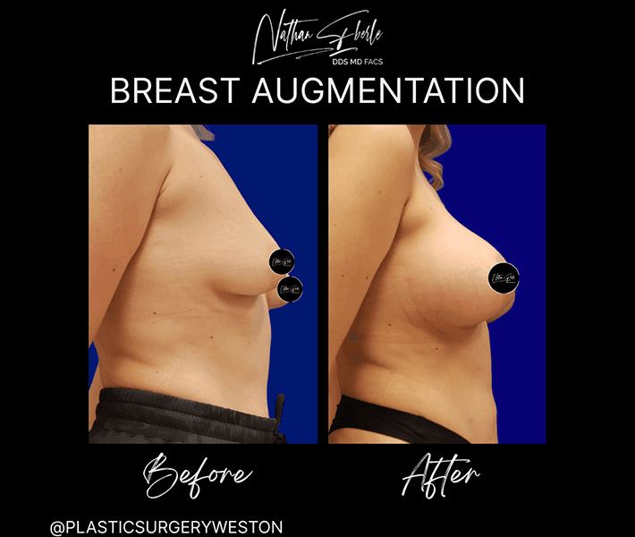 Breast Augmentation before and after case 114, actual patient at Weston Center for Plastic Surgery