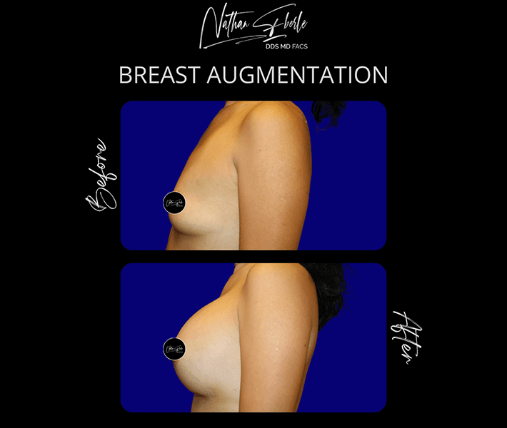 Breast Augmentation before and after case 12, actual patient at Weston Center for Plastic Surgery