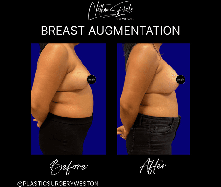 Breast Augmentation before and after case 123, actual patient at Weston Center for Plastic Surgery