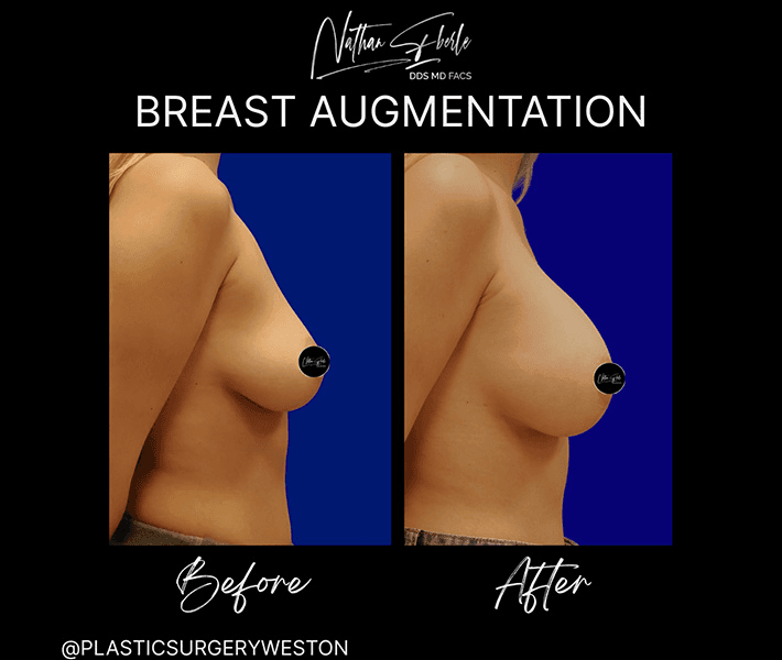 Breast Augmentation before and after case 126, actual patient at Weston Center for Plastic Surgery