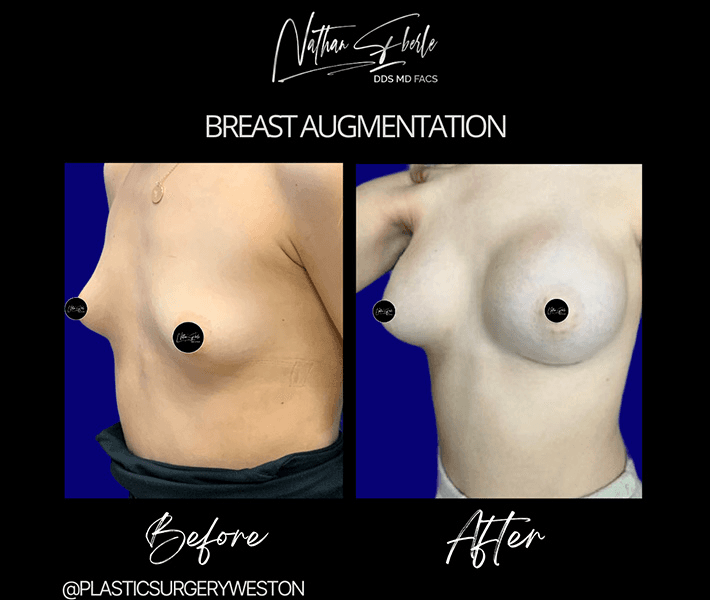 Breast Augmentation before and after case 128, actual patient at Weston Center for Plastic Surgery